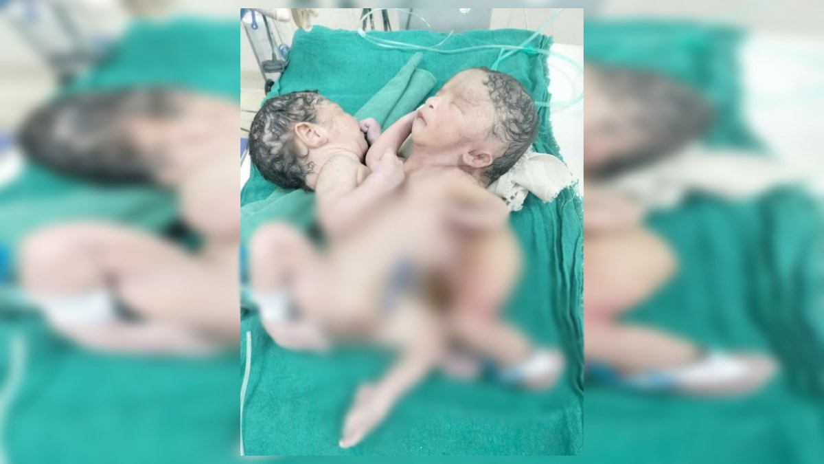 दो जिस्म एक जान: 4 हाथ-पैर, 2 सिर और एक पेट, अनोखे जुड़वा बच्चे को देख हर कोई हैरान, डॉक्टरों ने कही ये बात