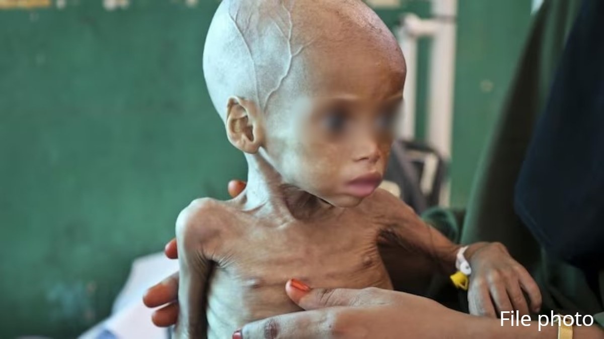 ओडिशा में 11,710 बच्चे गंभीर कुपोषण के शिकार, क्या कर रही सरकार ?