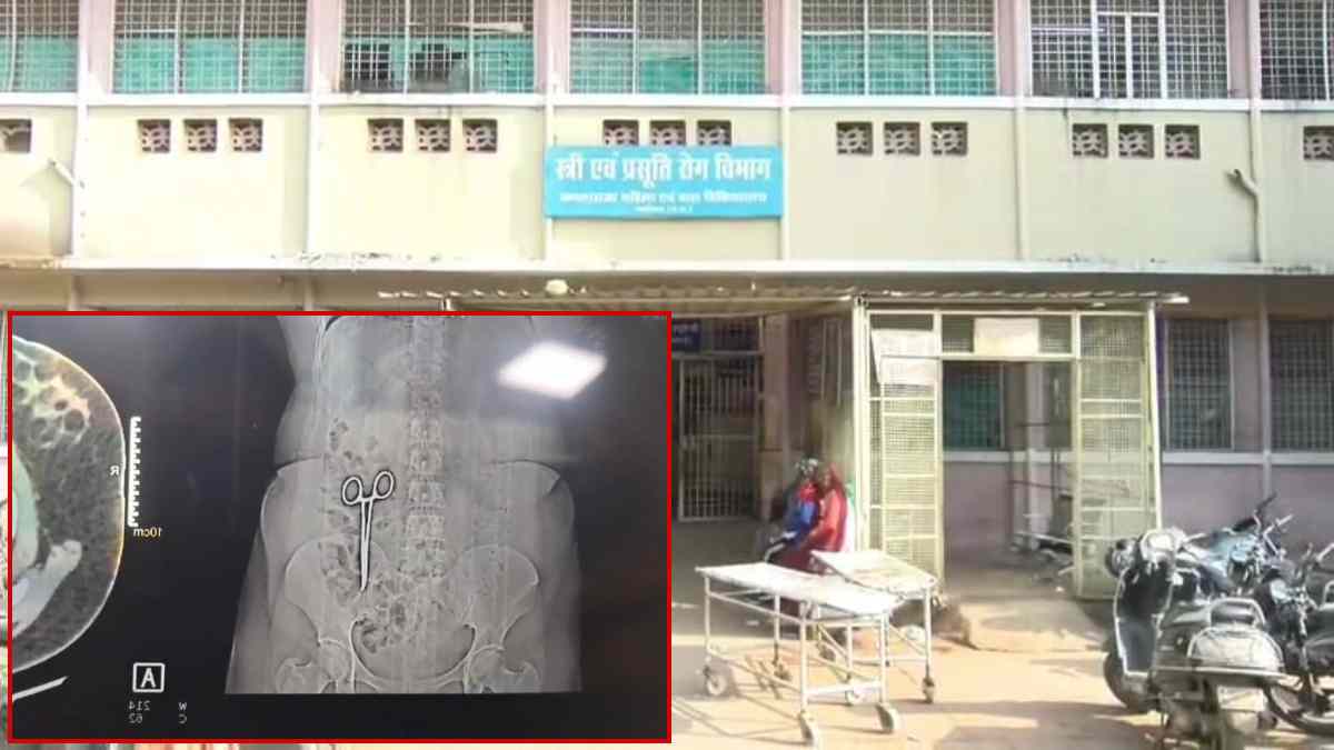 कैंची होने की शिकायत लेकर घूम रही महिला के पेट में निकला ‘मॉस्किटो आर्टरी फोर्सेप’, डॉक्टरों की लापरवाही आई सामने
