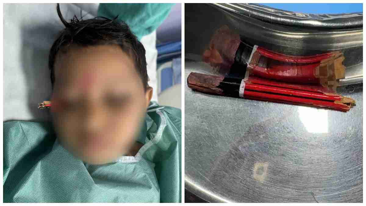 बच्ची की आंख में घुसी पेंसिल दिमाग की नसों तक धंसी: भोपाल AIIMS ने डेढ़ घंटे ऑपरेशन कर निकाला, आंगनवाड़ी में हुई थी घायल