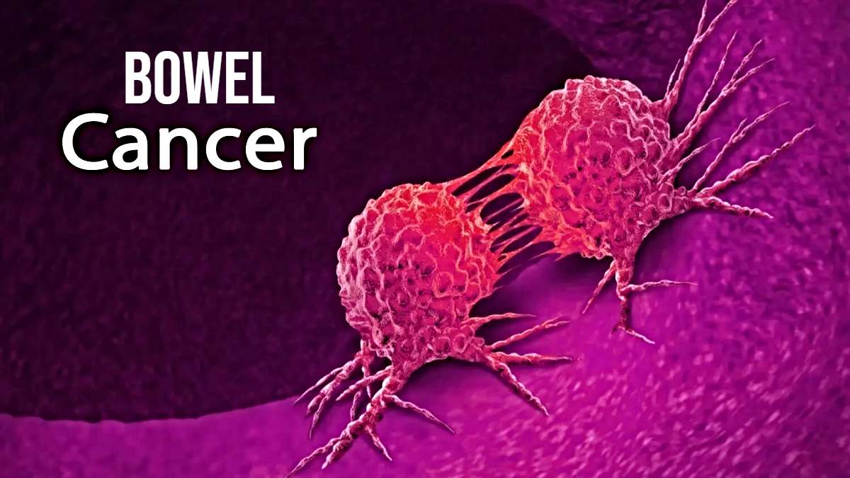 Bowel Cancer: जीवनशैली से जुड़ी आदतें बन रही हैं बाउल कैंसर की वजह, जानिए बचाव के लिए क्या कदम उठाएं…