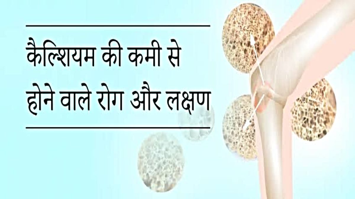 Calcium Ki Kami Ke Lakshan: अगर बॉडी में बाहर आए ऐसे लक्षण जो समझे Body में हो रही है कैल्शियम की कमी…