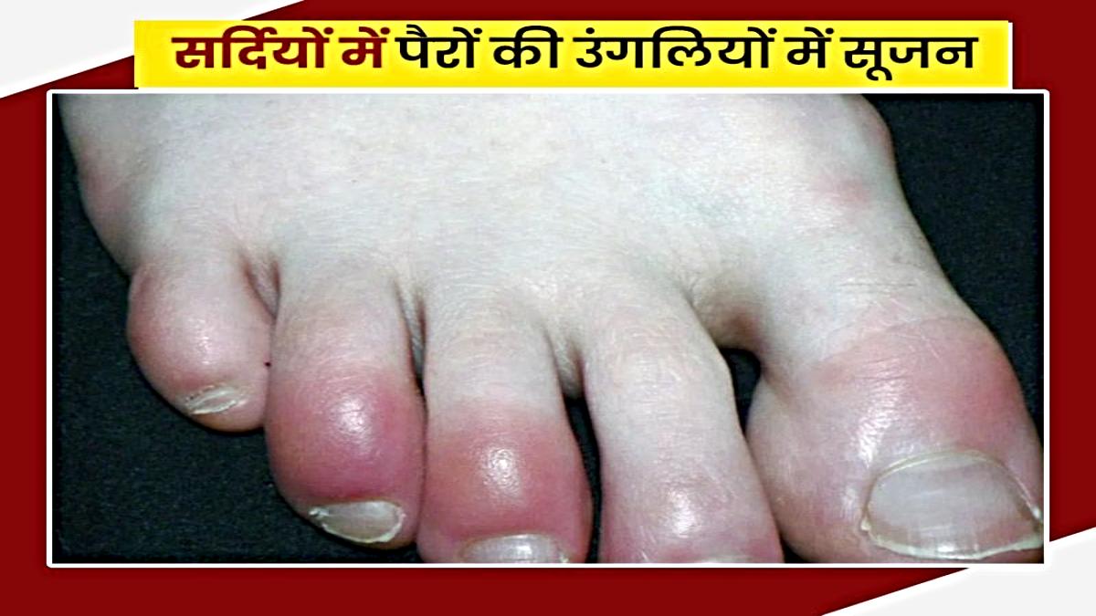 Winter Care Tips: ठंड ज़्यादा पड़ने से सूझ जाती है आपके पैरों की उँगलियाँ? तो इन घरेलू तरीकों से पाएँ राहत…