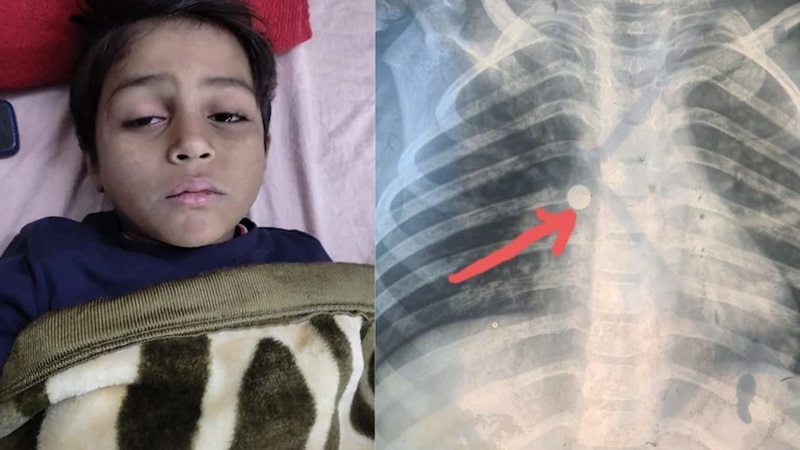 Rajasthan News: मध्य प्रदेश के शुभम को राजस्थान में मिला ‘जीवनदान’, डॉक्टर्स ने इस तरह बचाई जान