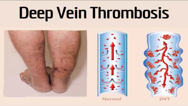 Deep Cein Thrombosis: पैरों में अचानक आई सूजन खतरनाक हो सकता है, ये हैं डीप वेन थ्रोम्बोसिस के संकेत…
