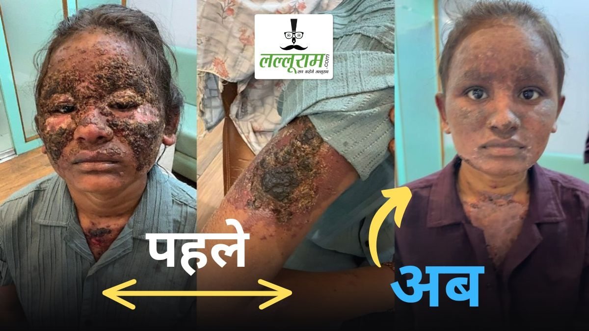 ऐसे भयावह हो गई थी बेटी की हालत… आईने में चेहरा देखने में भी लगता था डर, और अब…