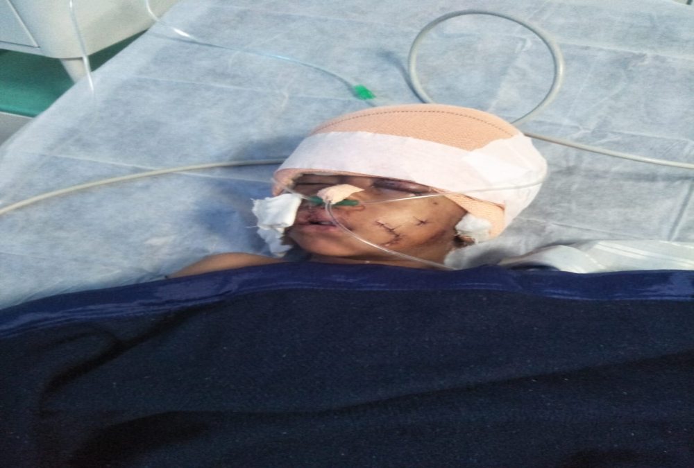 डॉग बाइट की अब तक की सबसे वीभत्स घटनाः 7 साल के मासूम को काटा, 18 जख्मों को भरने डॉक्टरों ने लगाए 107 टांके