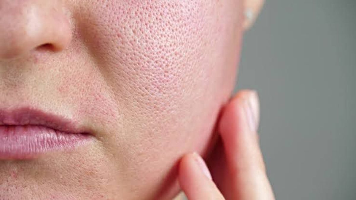 Skin Care Tips: आप भी ओपन पोर्स की समस्या से हैं परेशान? तो ये घरेलू उपाय आयेंगे काम…