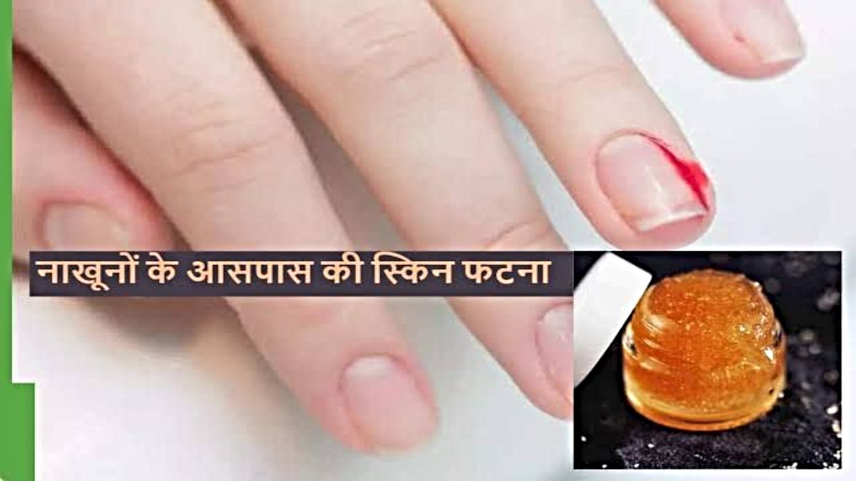 Peeling Cuticles: सर्दियों में छिल जाती है नाखून के आसपास की स्किन , इस दर्द से राहत लाने के लिए अपनाएं ये उपाय…
