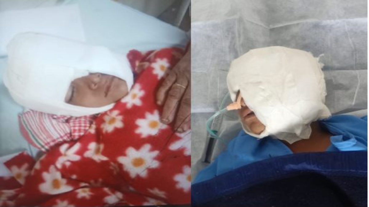 आवारा कुत्तों ने मासूम बच्चे को नोचाः तीन डॉक्टरों ने डेढ़ घंटे तक ऑपरेशन कर बचाई जान, चेहरे पर लगे 25 टांके