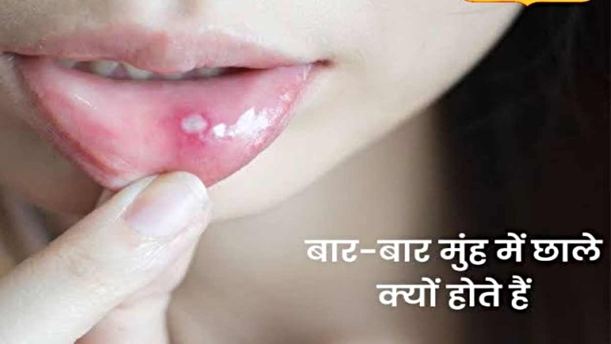 Mouth Ulcer Hone ke Karan: अगर मुंह में बार-बार हो रहे हैं छाले, तो शरीर में हो सकती हैं इन चीज़ों की कमी…