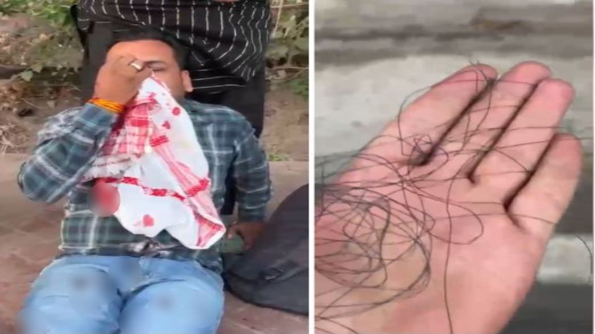 राजधानी में मांझे से कटी युवक की नाकः चलती बाइक पर अचानक आया चाइनीज मांझा, खून से लथपथ युवक अस्पताल में भर्ती