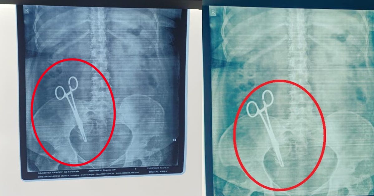 डॉक्टर ने पेट में छोड़ दी कैंची : 17 साल पहले हुआ था ऑपरेशन, X-ray निकाला तो हुआ चौंकाने वाला खुलासा, डॉक्टर्स भी रह गए हैरान