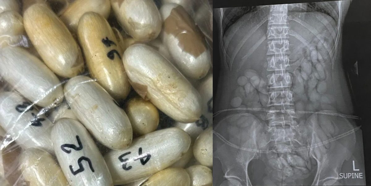 महिला के पेट में 10 करोड़ की कोकीन… ब्राजील से लेकर भारत पहुंची; एक चूक और इस तरह किए कराए पर फिर गया पानी