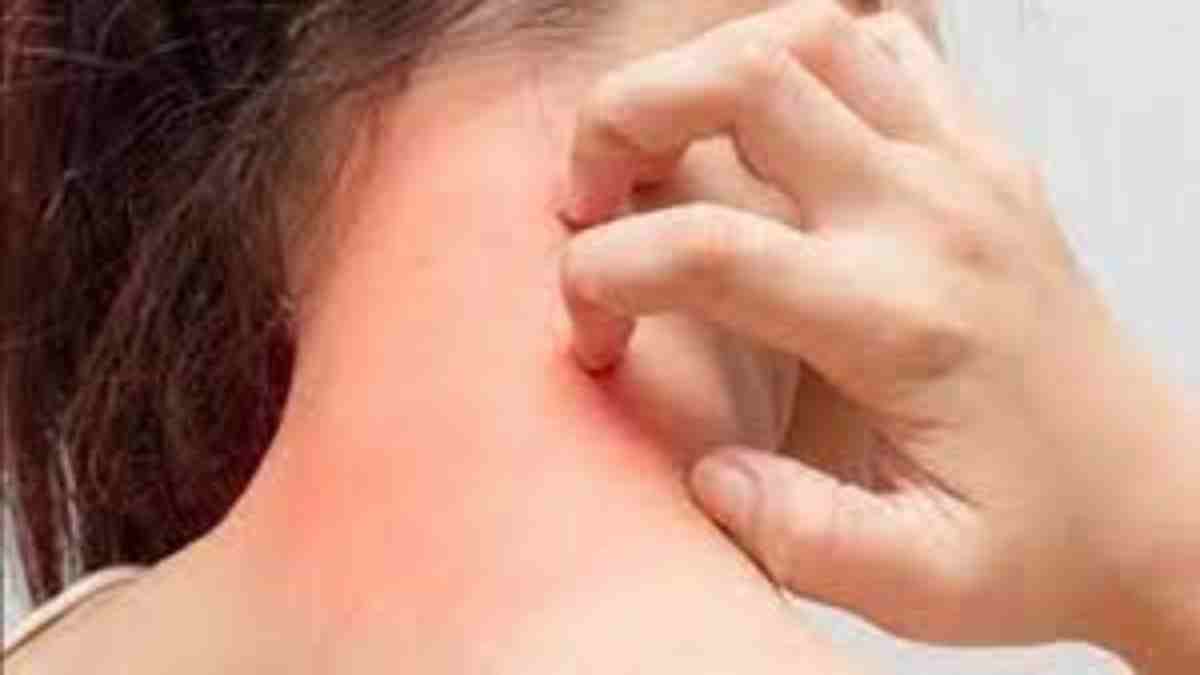 गर्मियों में होती है फंगल इंफेक्शन की समस्या, इन घरेलू उपायों से मिलेगी राहत