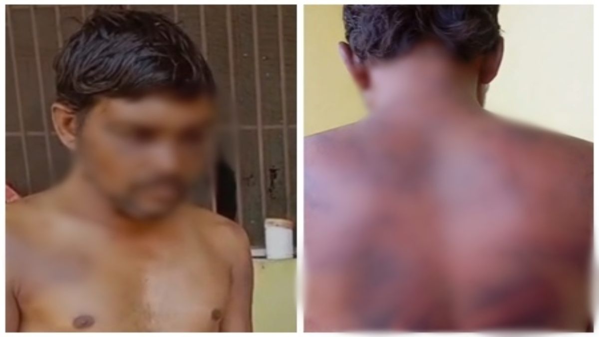 पुलिस कस्टडी में युवक को बेरहमी से पीटने का आरोप: हाथ-पीठ और चेहरे पर आई गंभीर चोट, समाजसेवी ने की जांच की मांग    