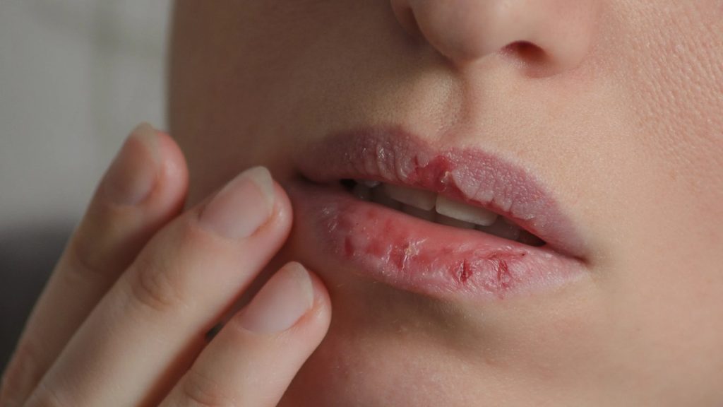Dry Lips