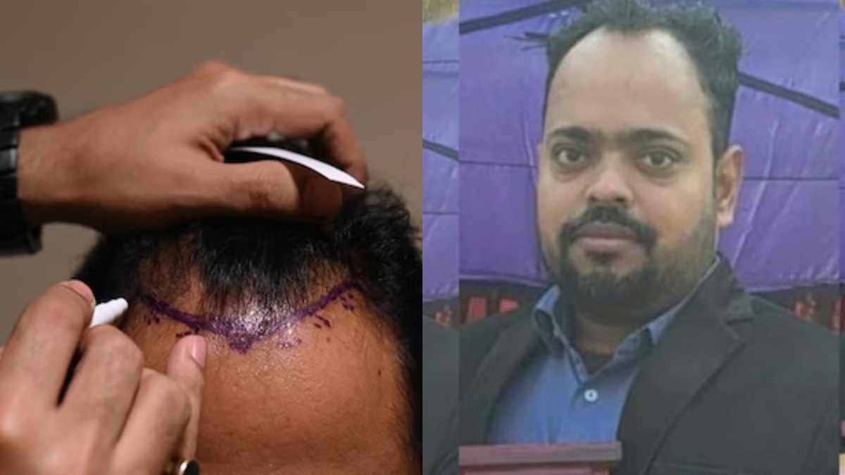 काले घने बालों की चाहत ने ले ली जान! हेयर ट्रांसप्लांट के दौरान इंजीनियर की मौत, जानिए आखिर ऐसा क्या हुआ?