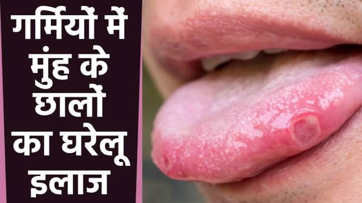 Mouth Ulcer Home Remedies: गर्मी के मौसम में बढ़ गई है मुंह में छालों की समस्या, इस तरीके से घर पर करें इसका इलाज…