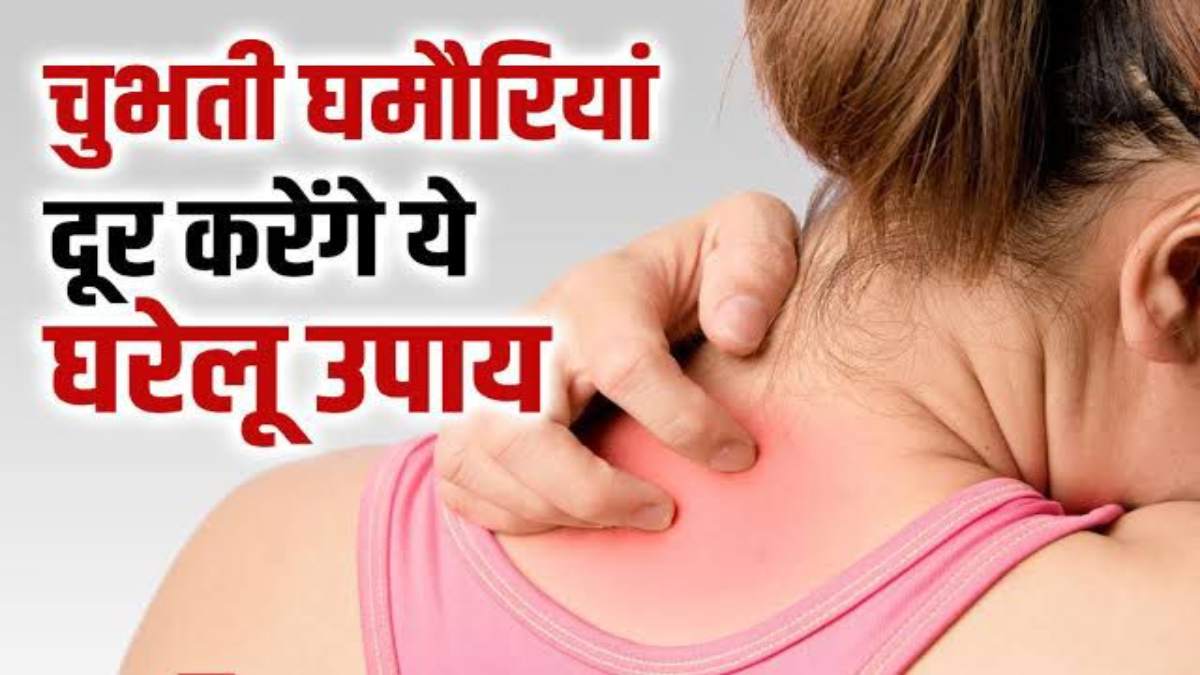 घमौरियों ने कर दिया है परेशान, तो अपनाएं ये घरेलू नुस्खें …