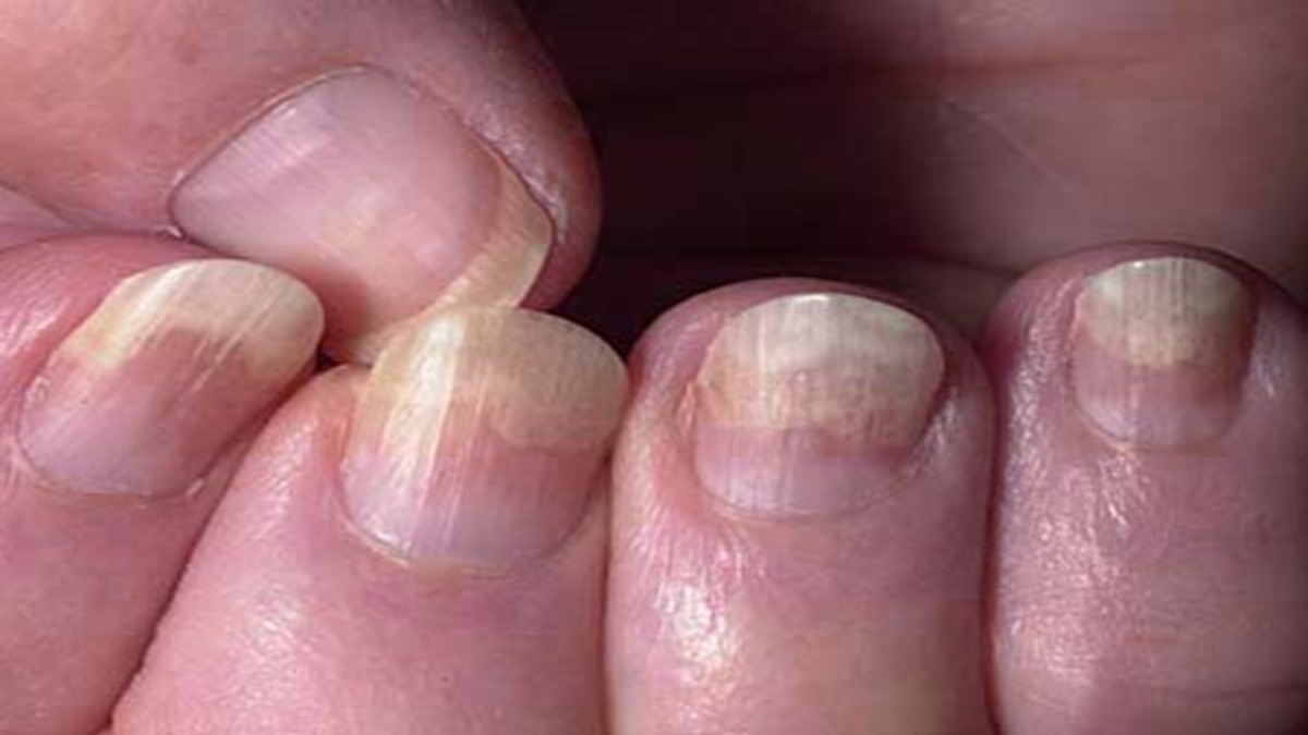 Health Care Tips: बदल रहा है नाखूनों का रंग? तो हो जाइए सावधान, ये हो सकते हैं किसी बीमारी के संकेत…