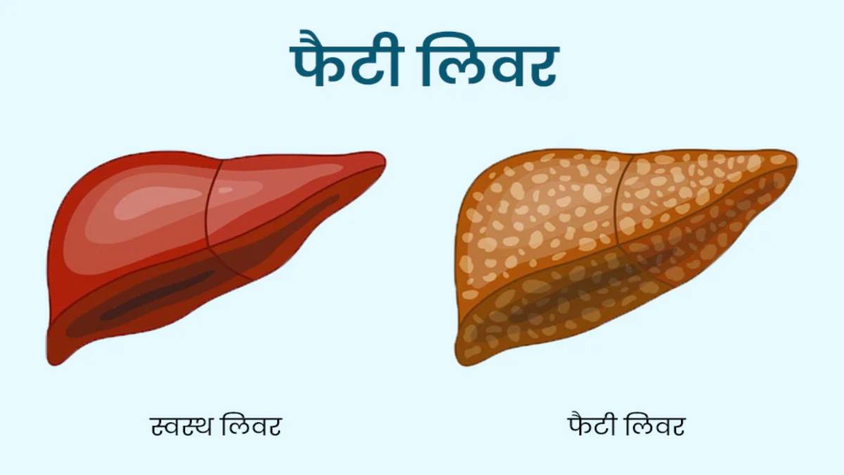 Health News: 90 CM से कमर ज्यादा तो फैटी लिवर हो सकता है, जांच के लिए सरकार ने की पायलट प्रोजेक्ट की शुरुआत