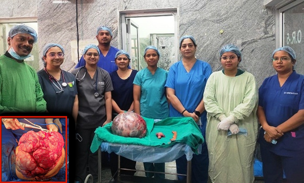 डॉक्टरों ने सर्जरी कर मरीज के पेट से निकाला 10.6 किलो का ट्यूमर, अंदर में 2 लीटर भरा था पानी ; सफदरजंग अस्पताल के डॉक्टरों ने महिला को दी नई जिंदगी