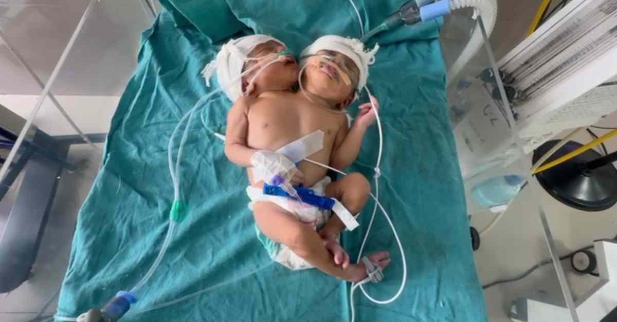 दो सिर-दो दिल वाली बच्ची का जन्म: सोनोग्राफी और एक्स-रे में नहीं हुआ था खुलासा, डॉक्टर भी हैरान, हालत नाजुक