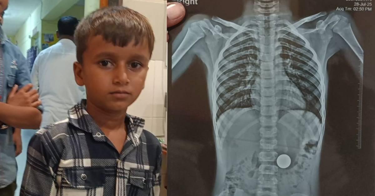 बच्चे का ख्याल नहीं रख सकते…? 8 वर्षीय बालक ने खेल-खेल में निगला 5 रूपए का सिक्का, फिर जो हुआ…
