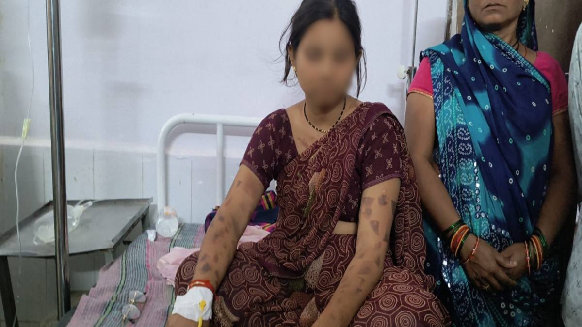 पति की हैवानियत: नवविवाहिता को गर्म चाकू से दागा, नहीं करता था पसंद, दहेज के लिए भी कर रहा था प्रताड़ित 