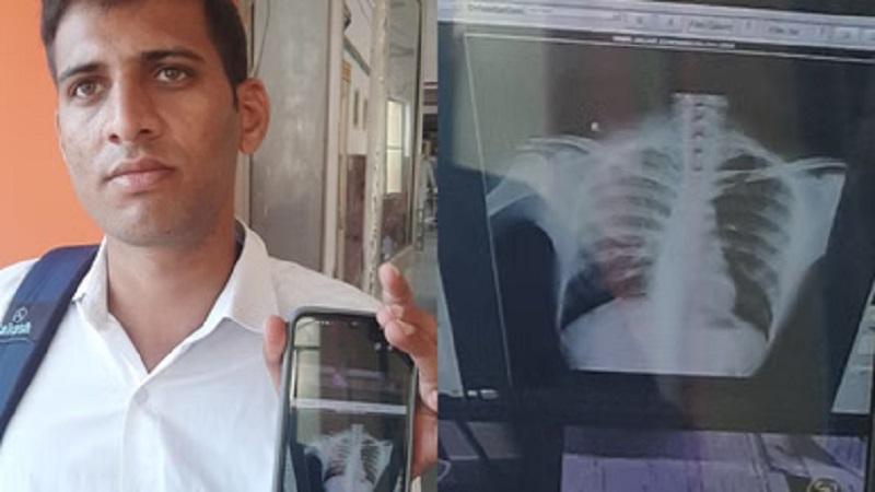 Rajasthan News: महाराणा भूपाल चिकित्सालय में एक्स-रे फिल्म की जगह मोबाइल और ग्लोसी पेपर, मरीज परेशान