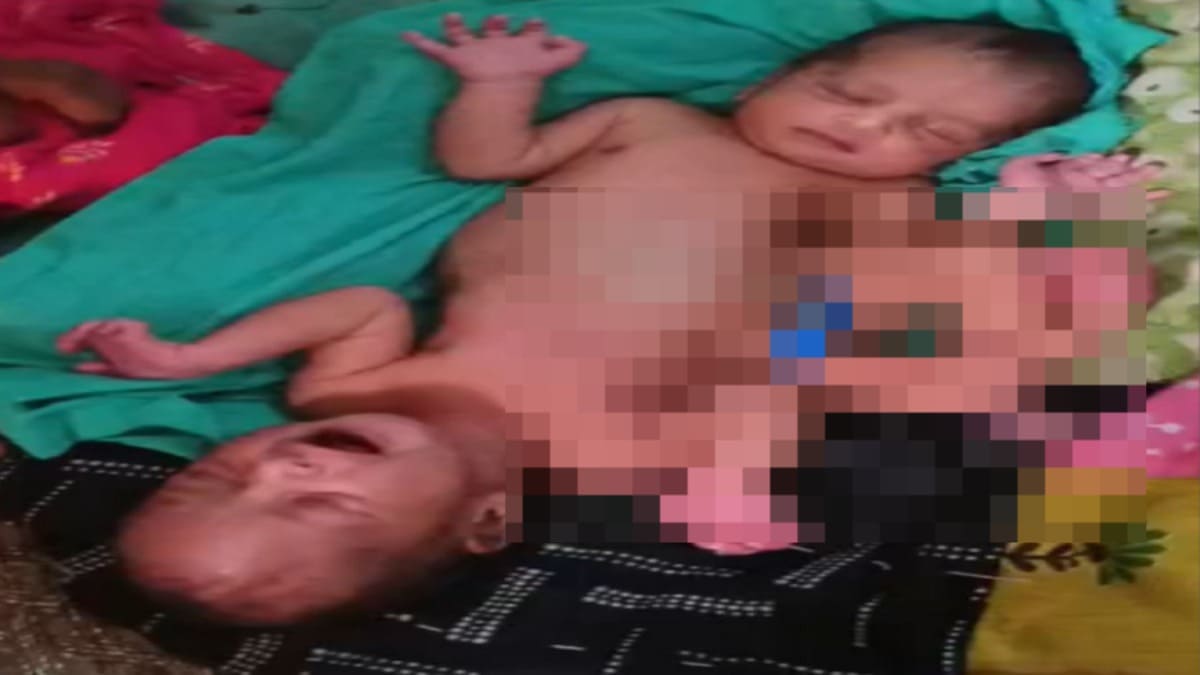 मुजफ्फरपुर में दो सिर वाली दुर्लभ बच्ची का जन्म, डॉक्टर भी हो गए हैरान