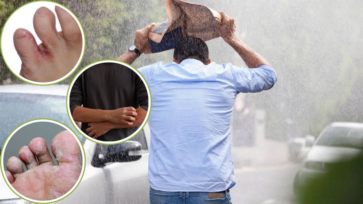 मानसून में बढ़ जाता है फंगल इंफेक्शन का खतरा, जानिए जरूरी हाइजीन टिप्स और घरेलू उपाय