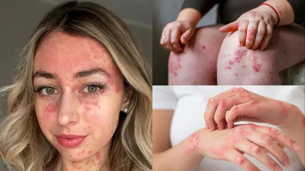 Skin Problems in Monsoon Season