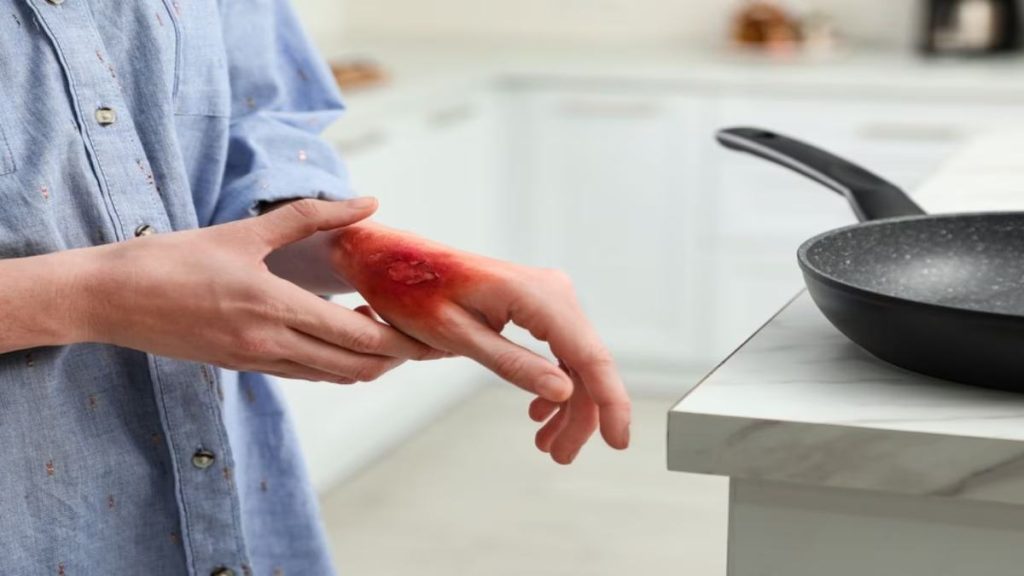 Home remedies for Kitchen Burns