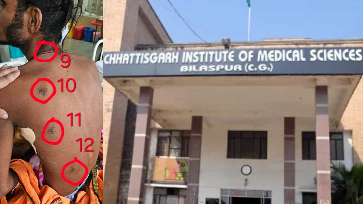 CG News : सिम्स के डॉक्टरों ने युवक को दिया नया जीवन, आरोपी ने 17 बार चाकू से किया था वार, फट गए थे फेफड़े