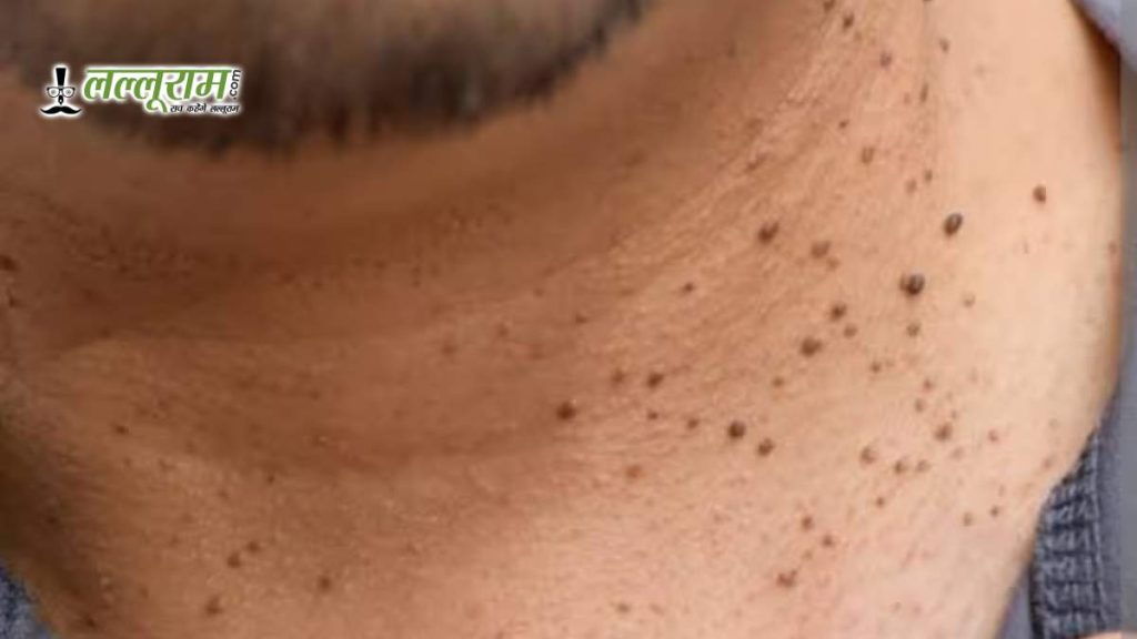Home Remedies for Warts