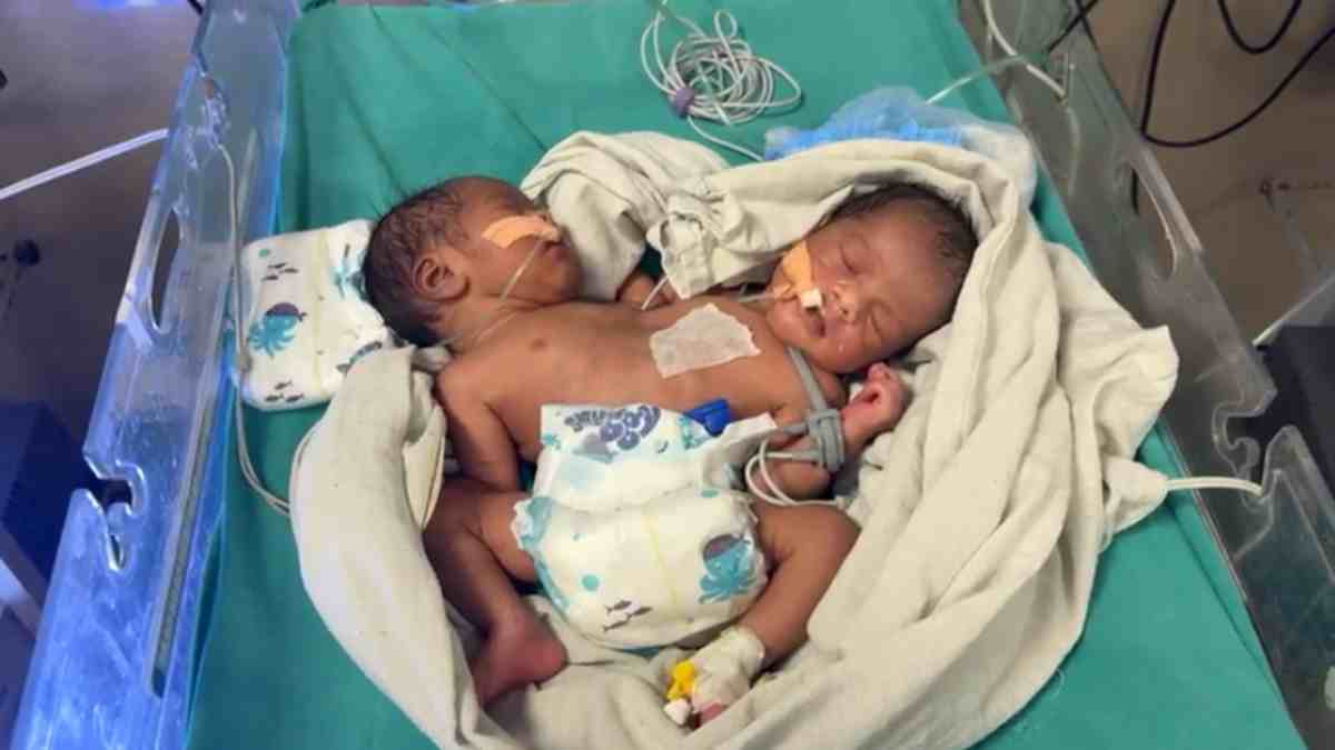 इंदौर में चमत्कार! 23 दिन बाद फिर हुआ दो सिर, दो दिल और दो पैर वाली बच्ची का जन्म, डॉक्टरों ने कही ये बात