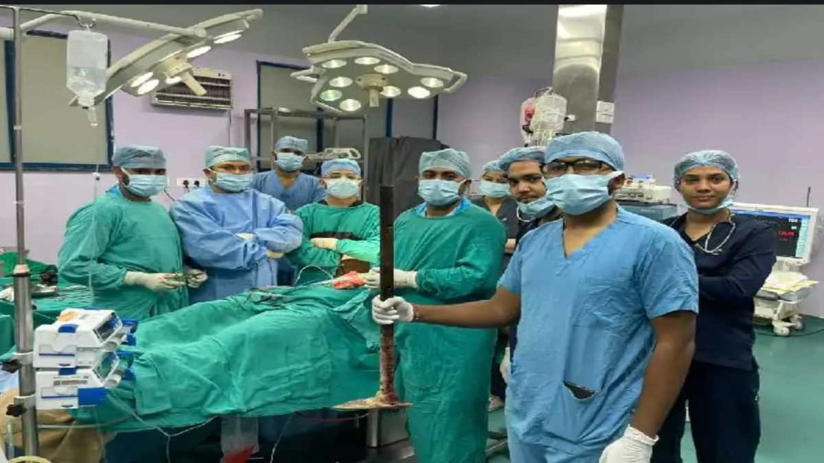 भोपाल एम्स में डॉक्टर बने भगवान: 90 मिनट की जटिल सर्जरी से मजदूर की सीने में धंसी लोहे की रॉड निकाली, बचाई जान 