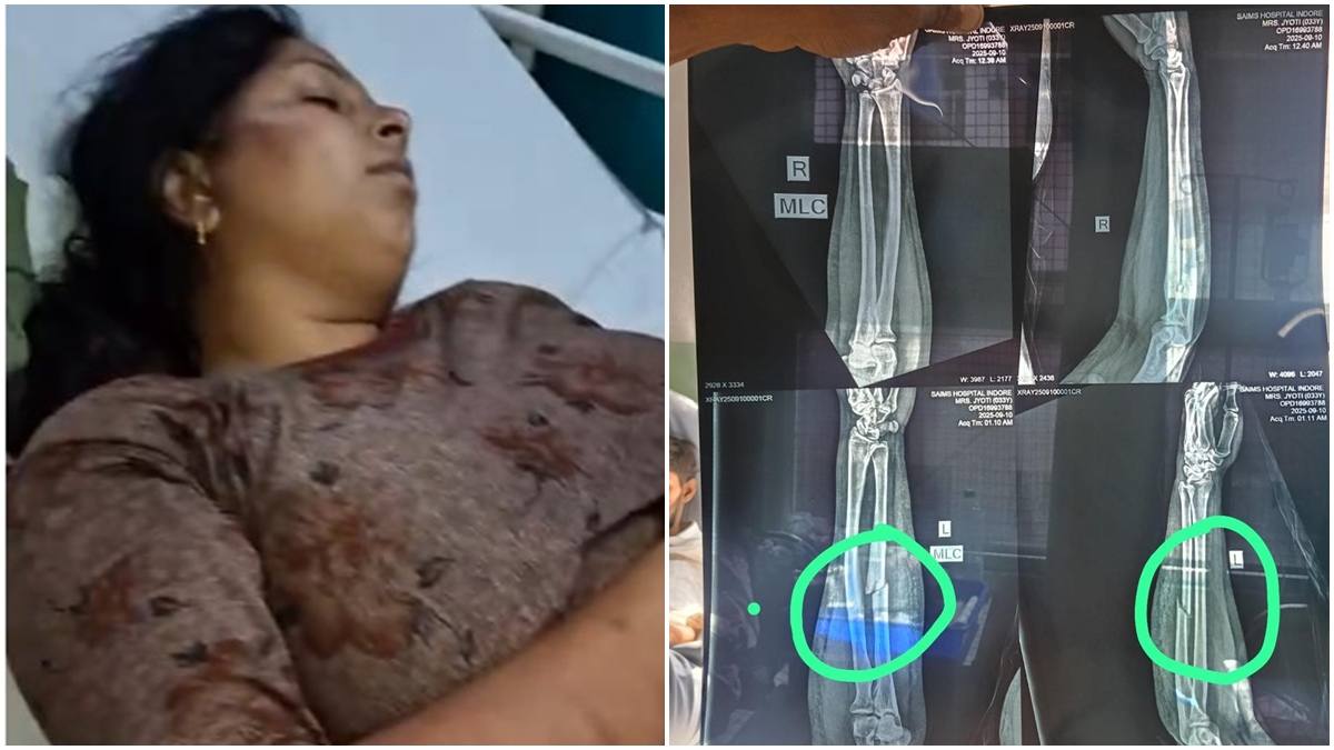 इंदौर की बेटी पर उज्जैन में अग्निसाक्षी जैसी घटना: पति ने किया हत्या का प्रयास, गंभीर हालत में अस्पताल में भर्ती