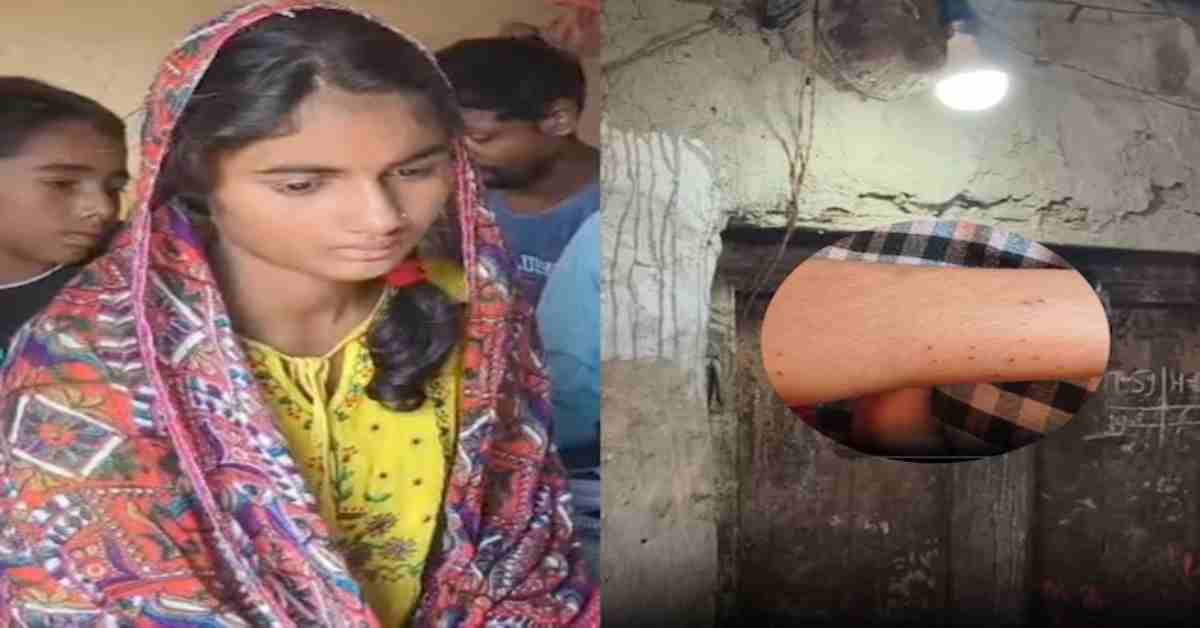 नाग की जानी दुश्मन बनी युवती! 42 दिन में पूरे बदन में 10 बार डसा, फिर भी जिंदा…