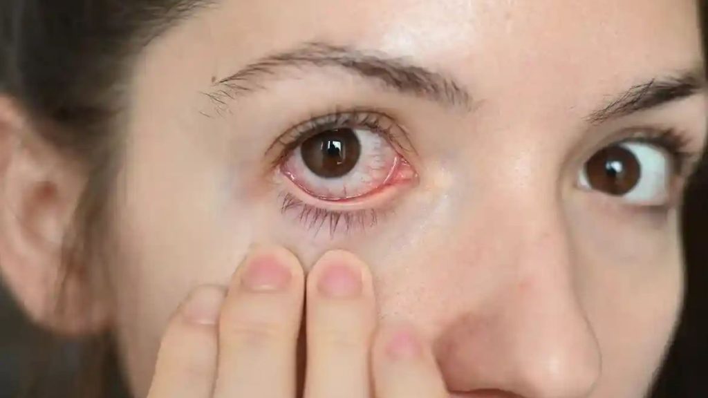 Dry Eye Syndrome