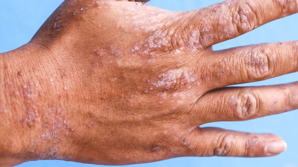 Eczema Skin Care Tips