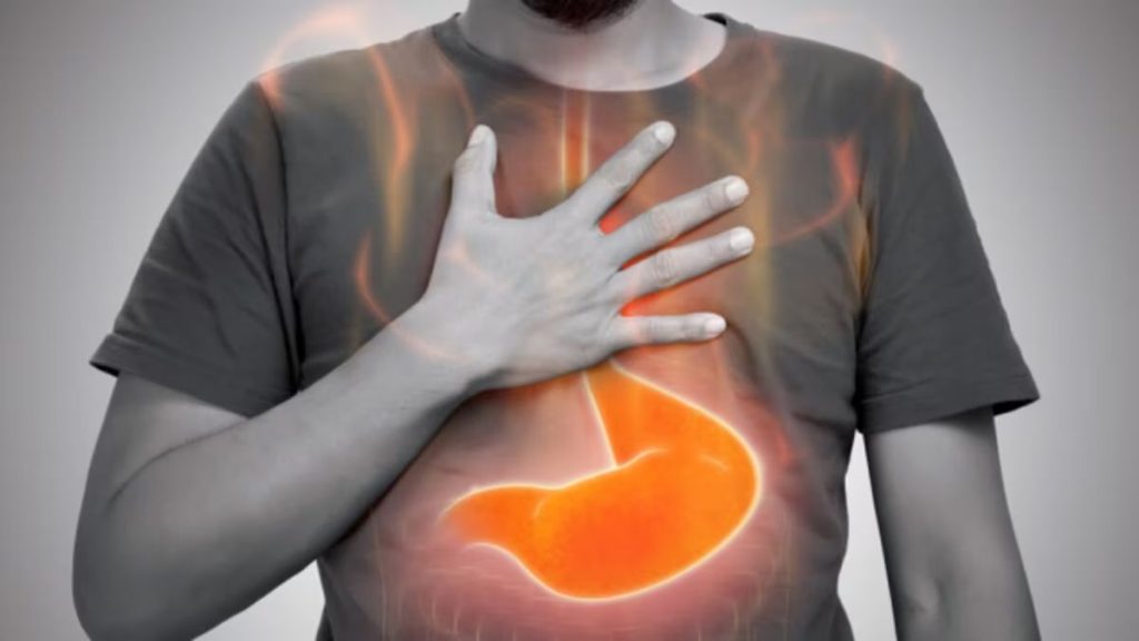 Acid Reflux Treatment Tips