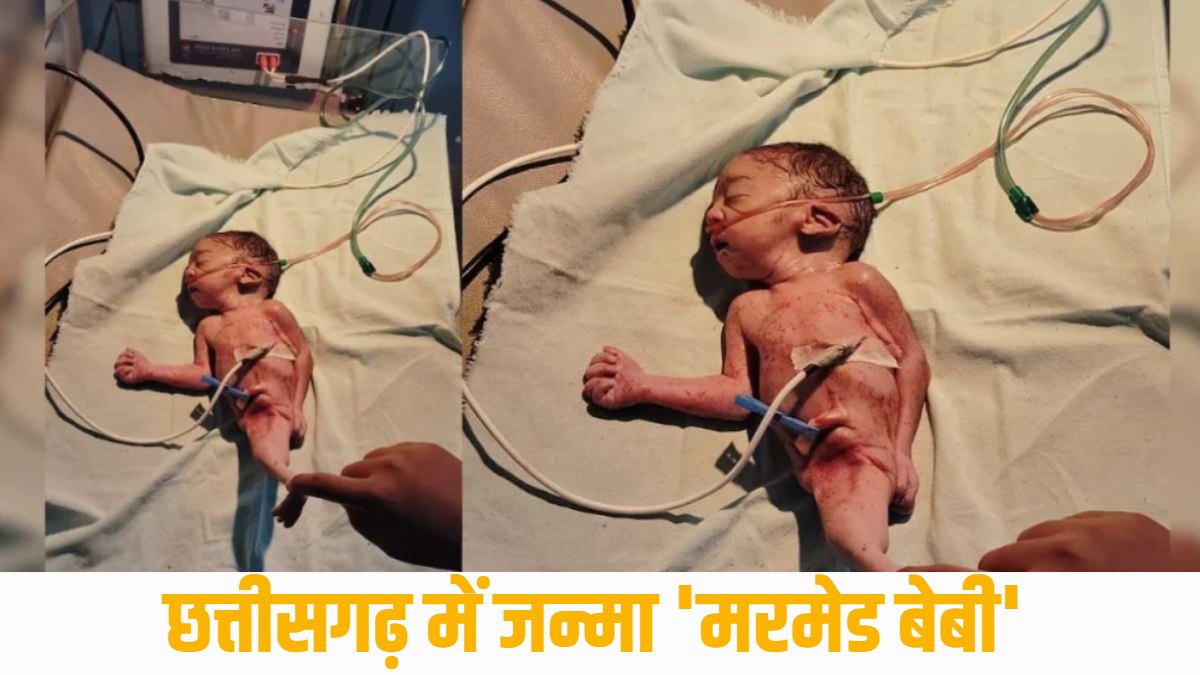 छत्तीसगढ़ में जन्मा ‘मरमेड बेबी’, सिर्फ 3 घंटे जीवित रहा नवजात, जलपरी जैसा था शरीर का निचला हिस्सा