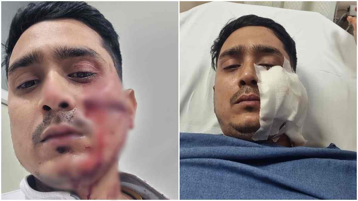 दो भाइयों के बीच विवाद में चली गोली: बीच बचाव करने आए दोस्त को लगी, बाल-बाल बची जान 