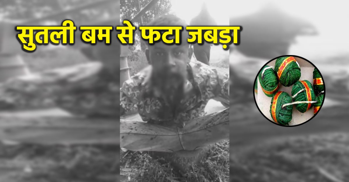 हीरोपंती पड़ी भारी: मुंह में रखकर फोड़ा सुतली बम, जबड़े के उड़े चिथड़े, हालत गंभीर