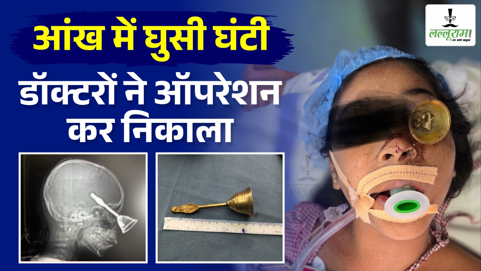 CG News: आंखों से होते हुए दिमाग में घुसी घंटी, डॉक्टरों ने ऑपरेशन कर निकाला