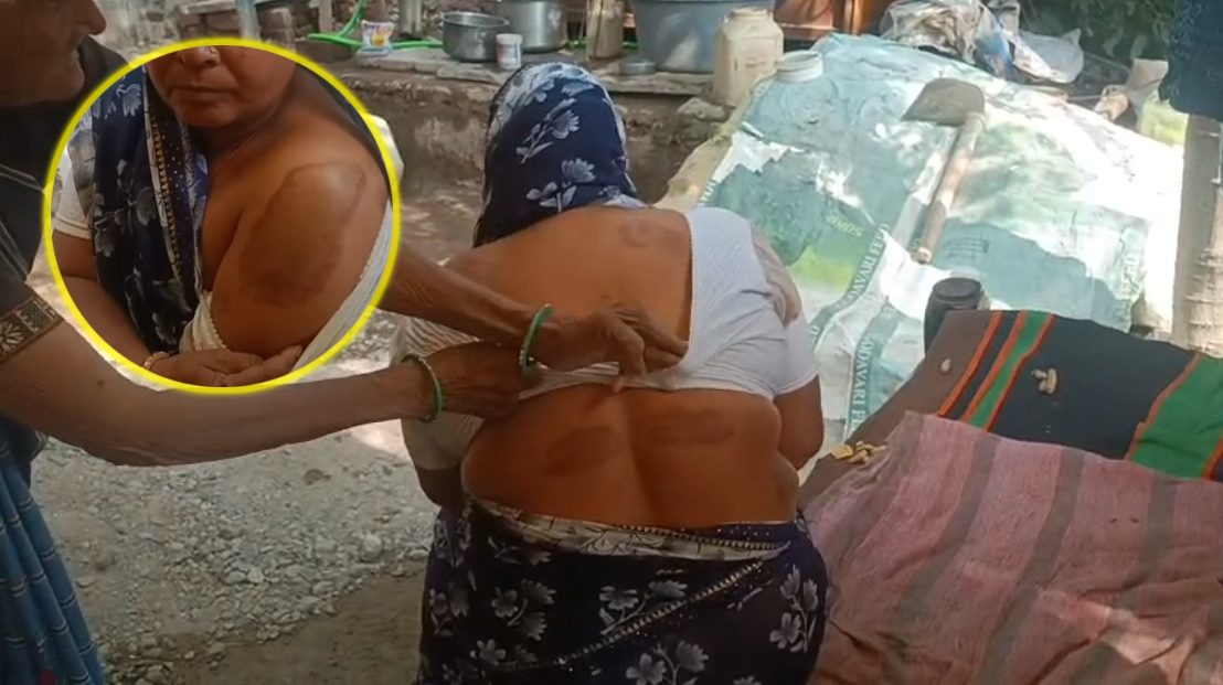 सीहोर में दबंगों के हौसले बुलंद: महिला को लाठी-डंडों से पीटा, शरीर पर कई जगह चोट के निशान, गांव से निकालने की धमकी भी दी