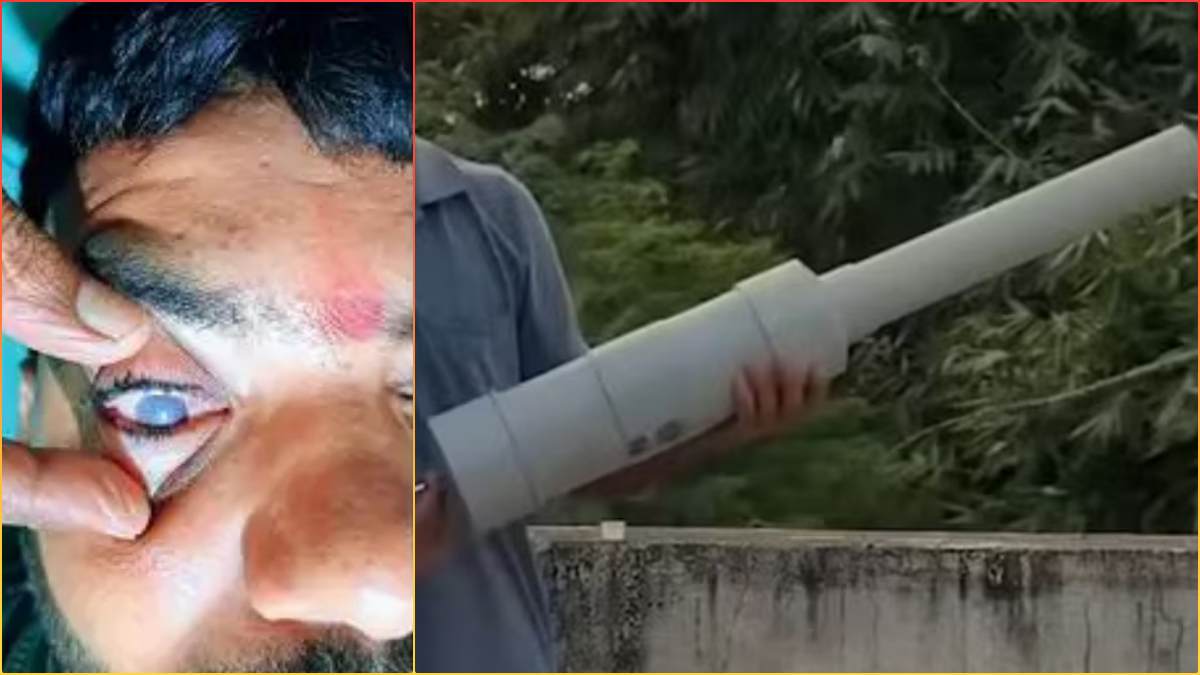 दिवाली पर जानलेवा बना देसी पटाखा: चिंगारी से 4 साल की अनुष्का की आंख की कॉर्निया में छेद, दिल्ली AIIMS रेफर, इधर कार्बाइड गन से 24 साल का सूरज भी चोटिल